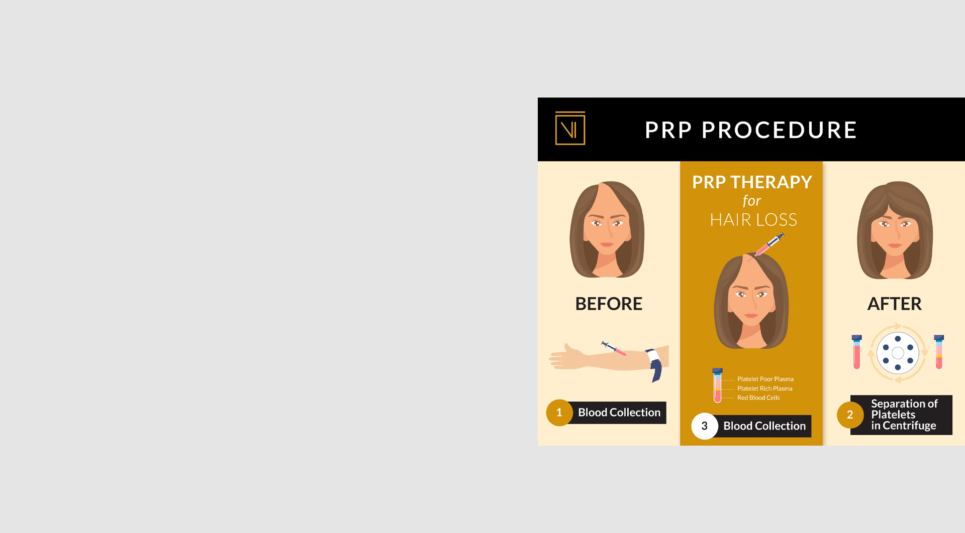 VIL_Clinic_PRP_Procedure_1920x1062_Slider_WithoutText