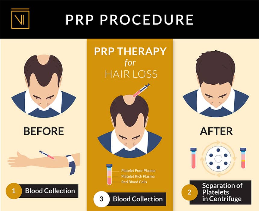 PRP_Procedure_Male